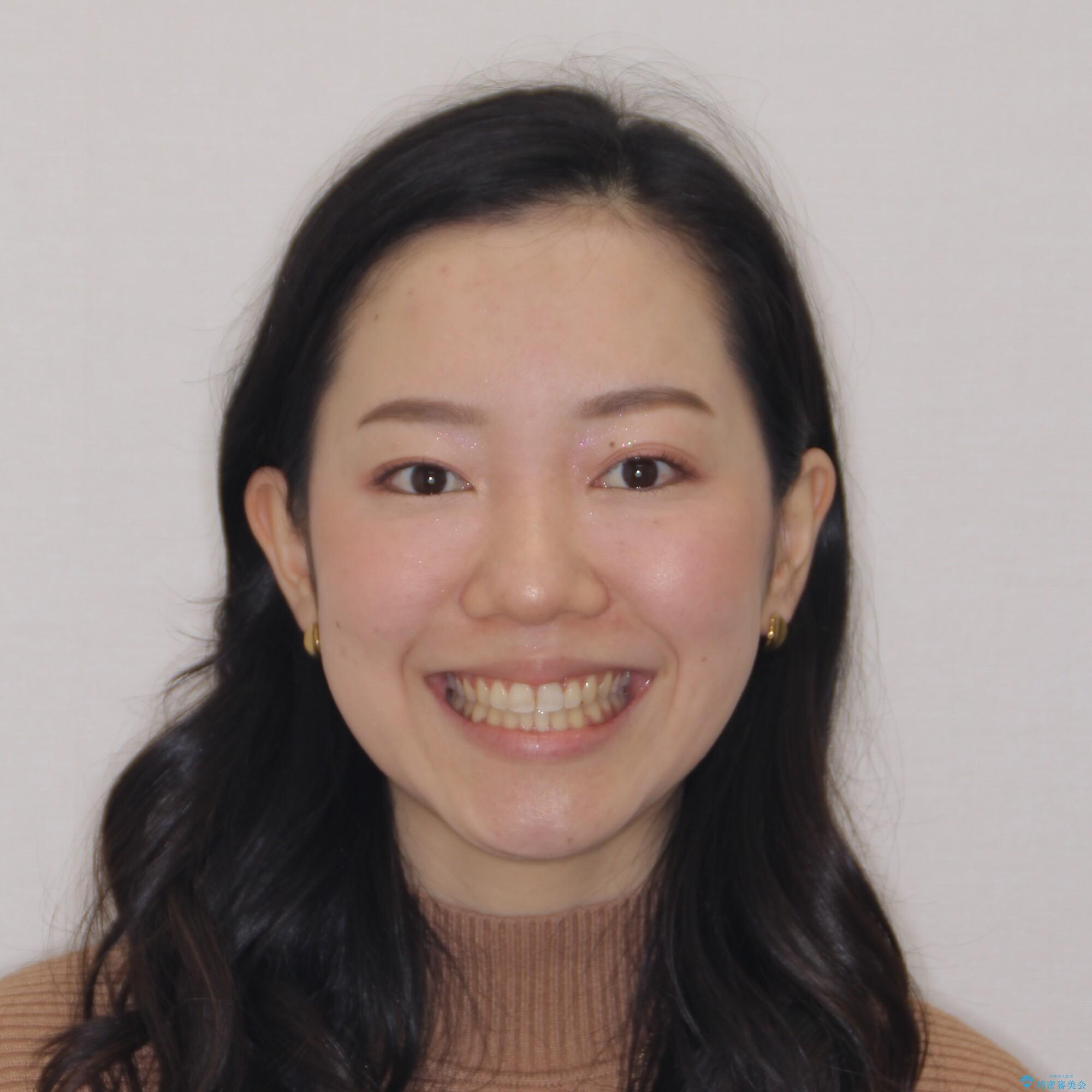 【モニター】オープンバイトをインビザラインで矯正治療の治療後(顔貌)