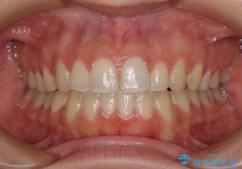 【モニター】オープンバイトをインビザラインで矯正治療