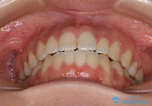 【モニター】オープンバイトをインビザラインで矯正治療の治療後