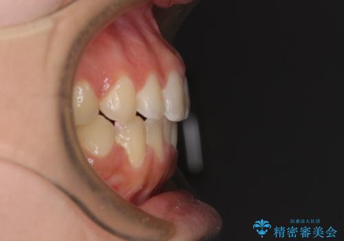 【モニター】オープンバイトをインビザラインで矯正治療の治療後