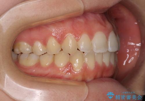 【モニター】オープンバイトをインビザラインで矯正治療の治療後