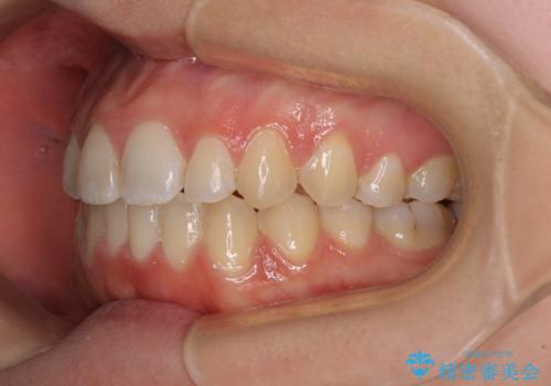 【モニター】オープンバイトをインビザラインで矯正治療の治療後