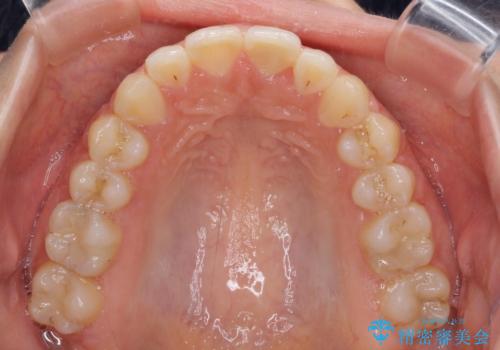 【モニター】オープンバイトをインビザラインで矯正治療の治療後