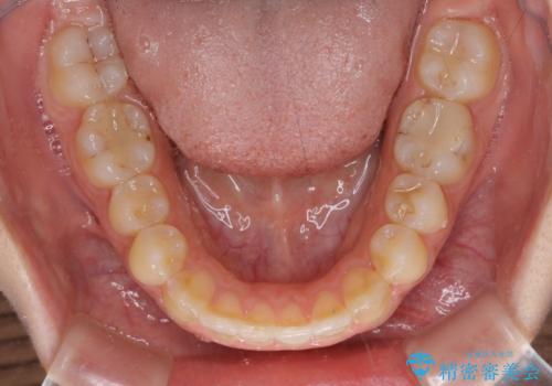 【モニター】オープンバイトをインビザラインで矯正治療の治療後