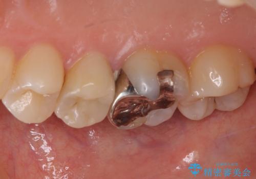 虫歯がしみる　セラミックインレーによる修復治療の治療後