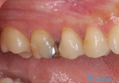 虫歯がしみる　セラミックインレーによる修復治療の治療後