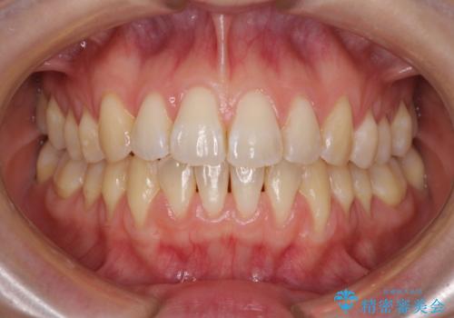 気になるデコボコとオープンバイト インビザラインでの矯正治療の症例 治療後