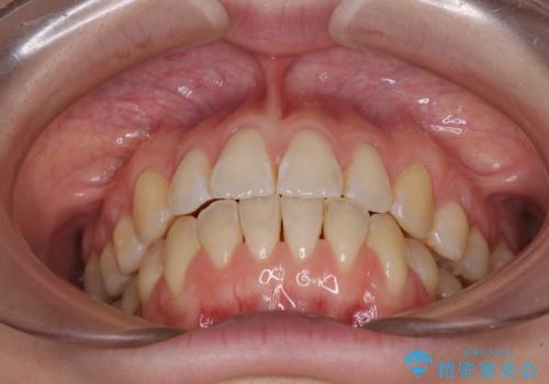 気になるデコボコとオープンバイト インビザラインでの矯正治療の治療後