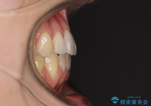気になるデコボコとオープンバイト インビザラインでの矯正治療の治療後