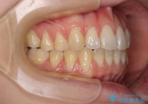 気になるデコボコとオープンバイト インビザラインでの矯正治療の治療後