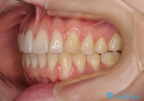 気になるデコボコとオープンバイト インビザラインでの矯正治療の治療後