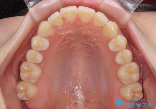 気になるデコボコとオープンバイト インビザラインでの矯正治療の治療後