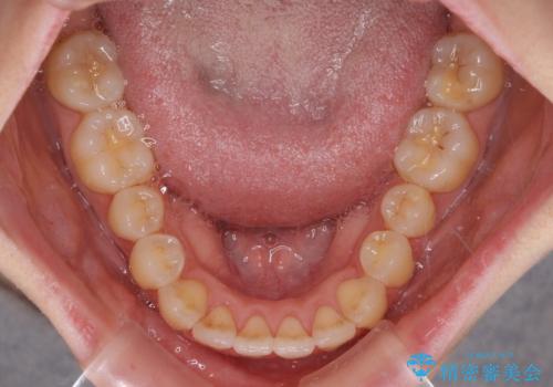 気になるデコボコとオープンバイト インビザラインでの矯正治療の治療後