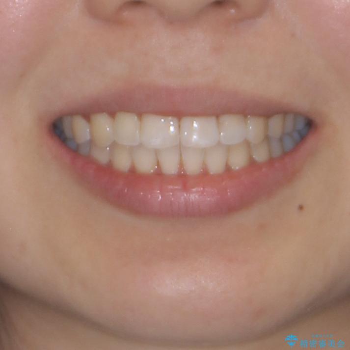 前歯のデコボコが気になる インビザラインによる矯正治療の治療後(顔貌)