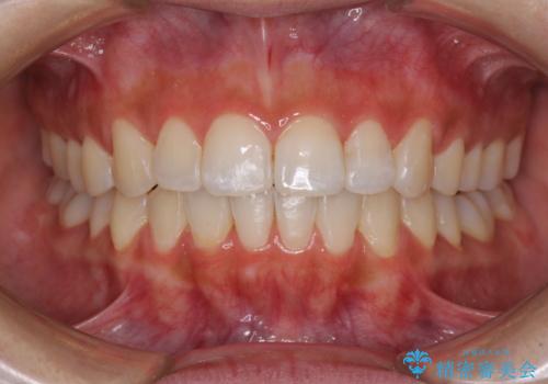 前歯のデコボコが気になる　インビザラインによる矯正治療の症例 治療後