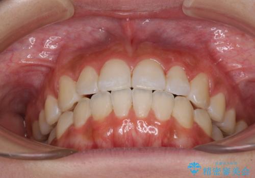 前歯のデコボコが気になる インビザラインによる矯正治療の治療後