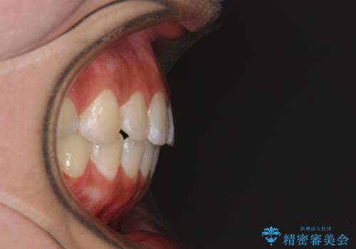 前歯のデコボコが気になる　インビザラインによる矯正治療の治療後
