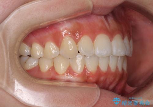 前歯のデコボコが気になる インビザラインによる矯正治療の治療後