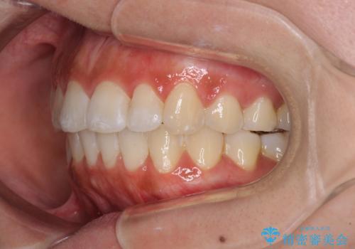 前歯のデコボコが気になる インビザラインによる矯正治療の治療後