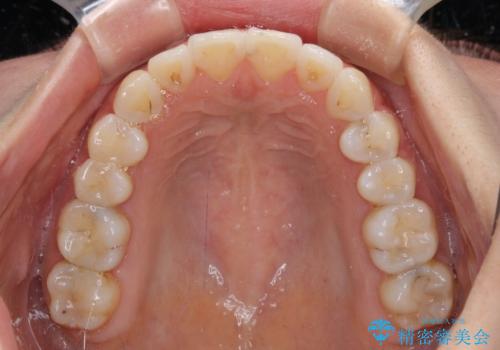 前歯のデコボコが気になる インビザラインによる矯正治療の治療後