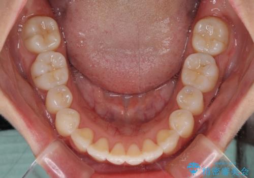 前歯のデコボコが気になる インビザラインによる矯正治療の治療後