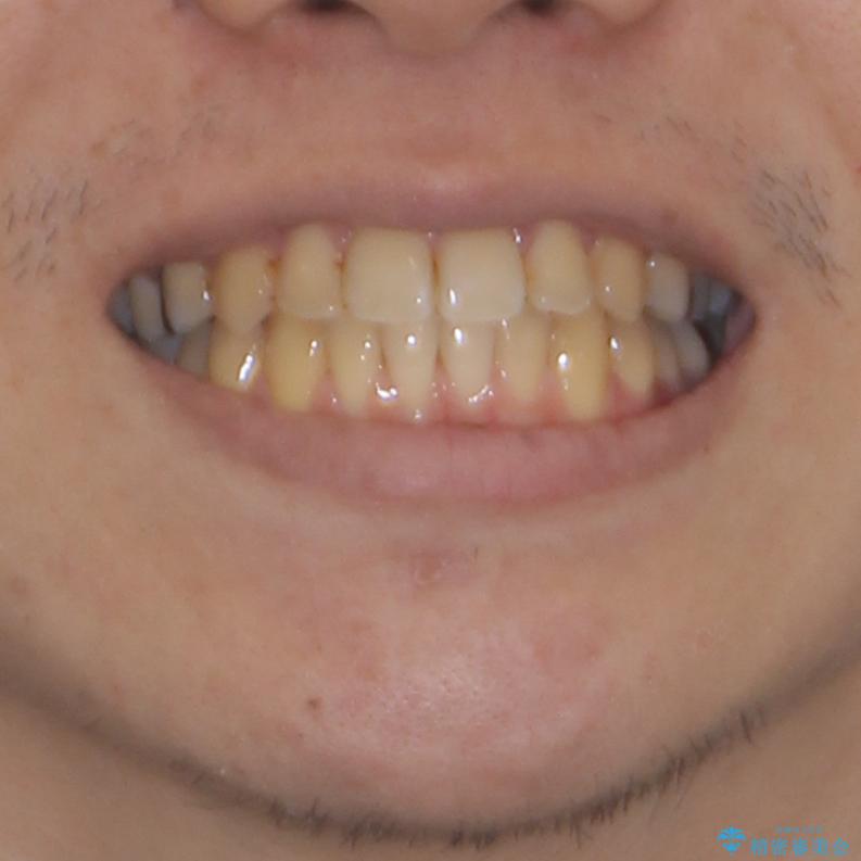 前歯のクロスバイトをインビザラインで矯正治療の治療後（顔貌）