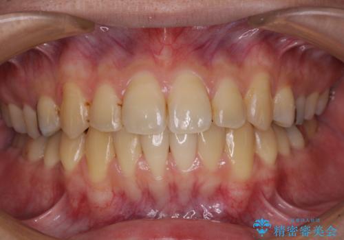 前歯のクロスバイトをインビザラインで矯正治療の症例 治療後