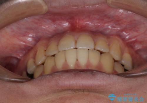 前歯のクロスバイトをインビザラインで矯正治療の治療後