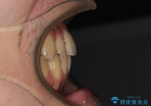 前歯のクロスバイトをインビザラインで矯正治療の治療後