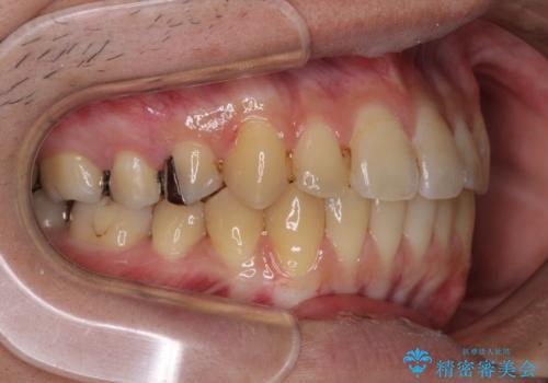 前歯のクロスバイトをインビザラインで矯正治療の治療後