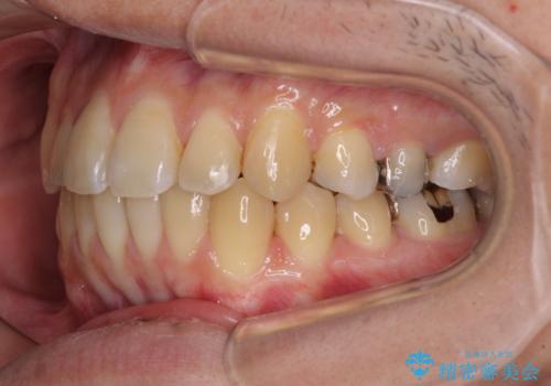 前歯のクロスバイトをインビザラインで矯正治療の治療後