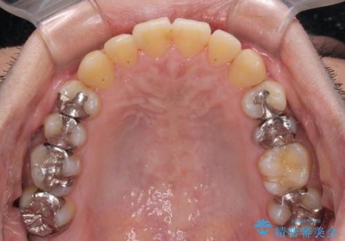 前歯のクロスバイトをインビザラインで矯正治療の治療後