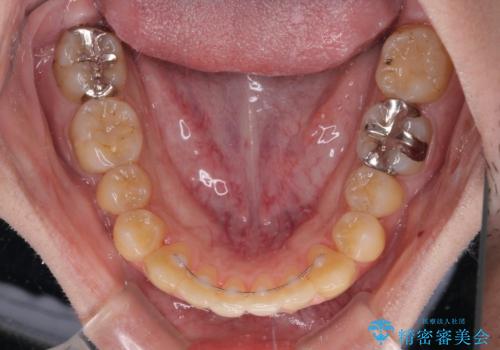 前歯のクロスバイトをインビザラインで矯正治療の治療後
