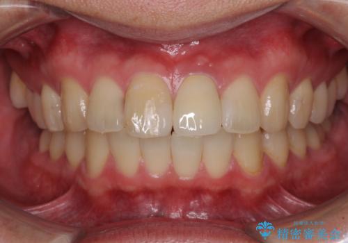 前歯の変色が気になる オールセラミッククラウンによる審美歯科治療の治療後