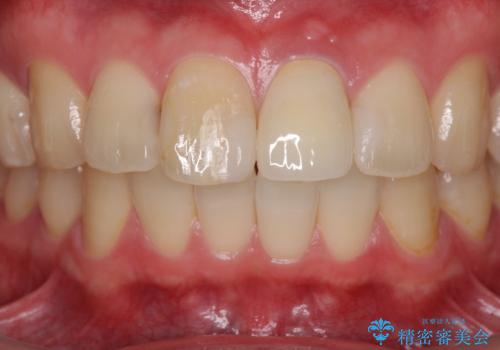 前歯の変色が気になる　オールセラミッククラウンによる審美歯科治療の治療後