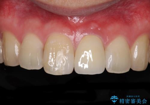 前歯の変色が気になる　オールセラミッククラウンによる審美歯科治療の症例 治療後