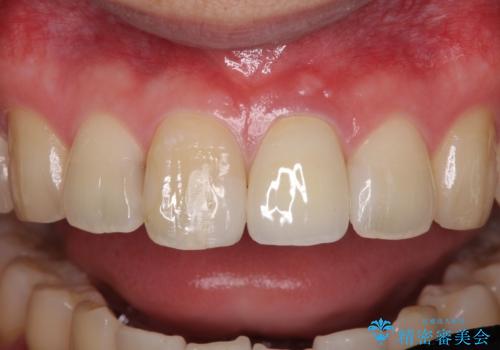 前歯の変色が気になる オールセラミッククラウンによる審美歯科治療の治療後