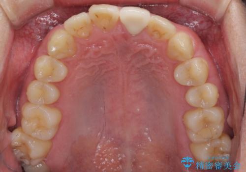 前歯の変色が気になる オールセラミッククラウンによる審美歯科治療の治療後