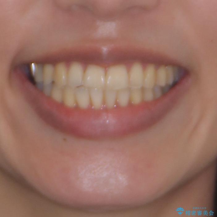 切端咬合をインビザライン矯正で解消の治療後(顔貌)
