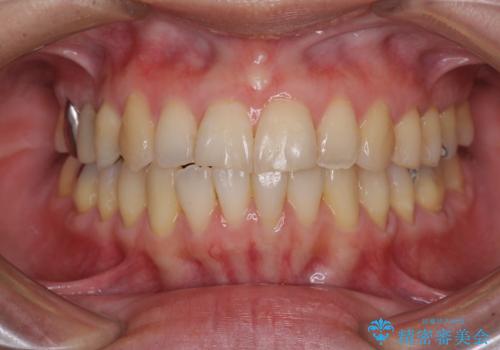 切端咬合をインビザライン矯正で解消の治療後