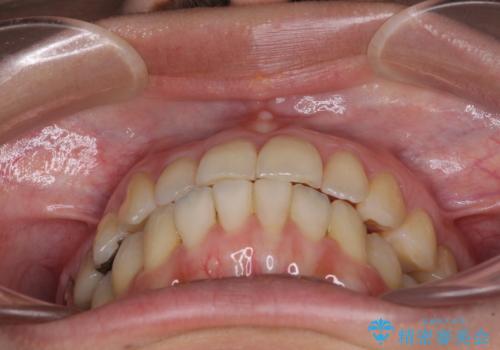 切端咬合をインビザライン矯正で解消の治療後