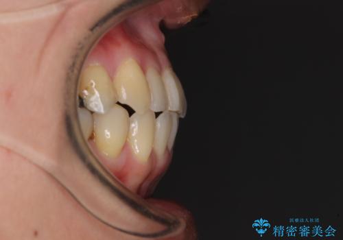 切端咬合をインビザライン矯正で解消の治療後