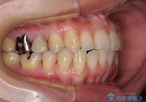 切端咬合をインビザライン矯正で解消の治療後