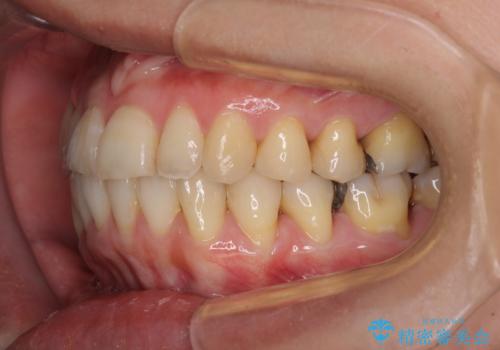 切端咬合をインビザライン矯正で解消の治療後