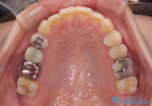 切端咬合をインビザライン矯正で解消の治療後