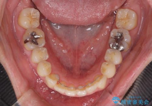 切端咬合をインビザライン矯正で解消の治療後