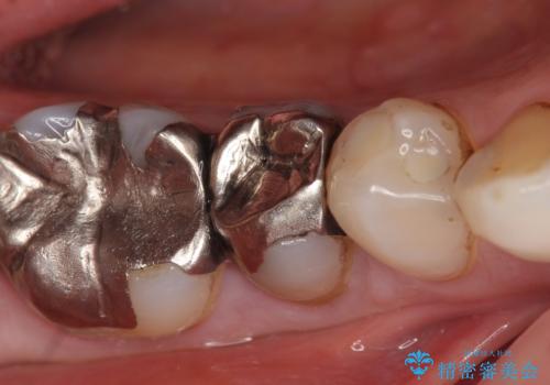 オールセラミッククラウン 違和感のある奥歯の治療の治療前