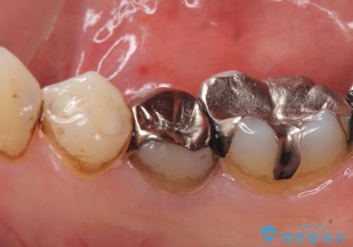 オールセラミッククラウン 違和感のある奥歯の治療の治療前