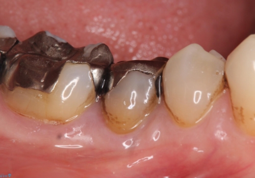 オールセラミッククラウン 違和感のある奥歯の治療の治療前