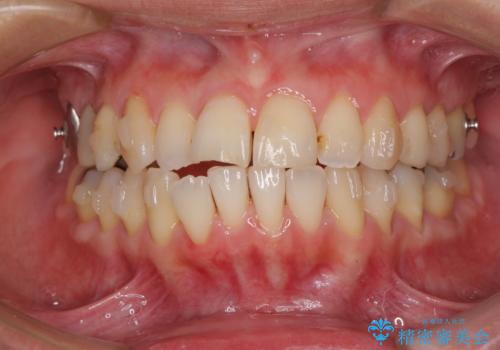 切端咬合をインビザライン矯正で解消の治療中